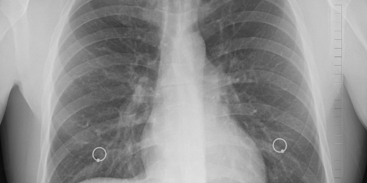 Туберкулез – опасное заболевание
