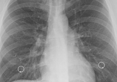 Туберкулез – опасное заболевание